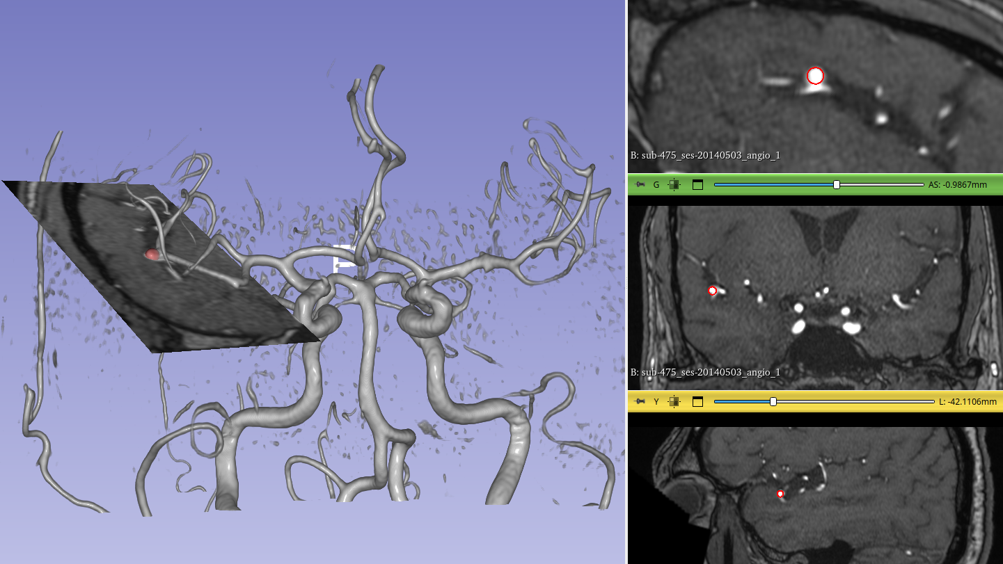 Anévrisme détecté automatiquement par notre algorithme dans un volume d'IRM angiographique. À gauche : vue 3D ; bandeau de droite: 3 coupes dans le volume IRM. 