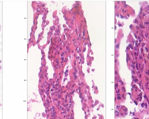 AI to improve prevention of lung transplant rejection